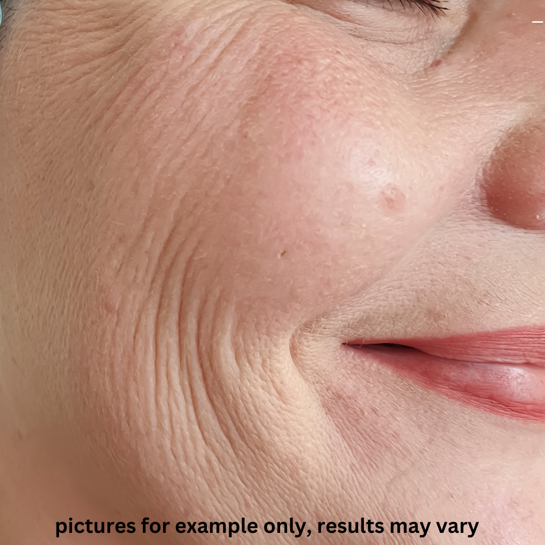 Firmness & Texture Focus — Before
