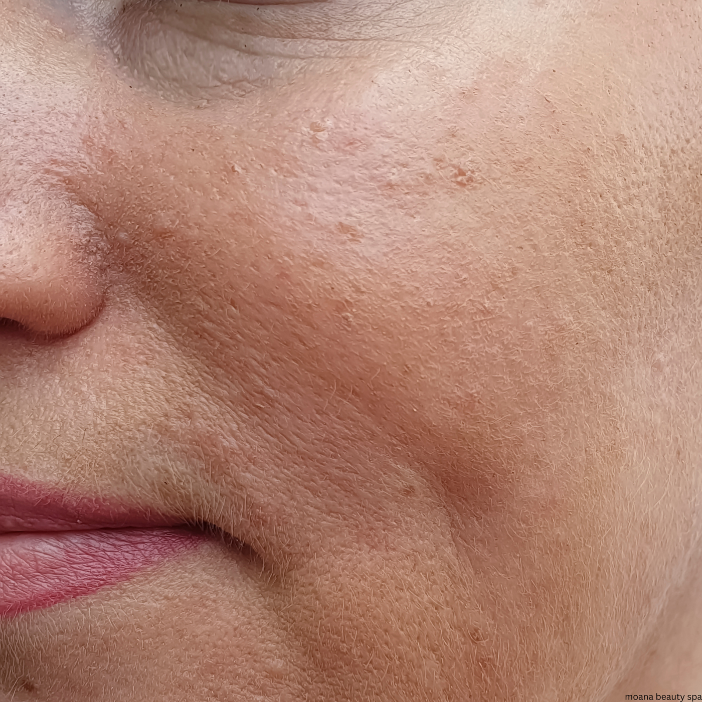 Skin Texture Appearance — before